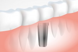 <p>Bio implants</p>